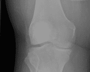 Normal knee radiograph