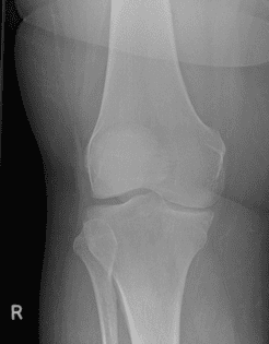 Normal knee radiograph