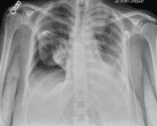 Pneumothorax Differential