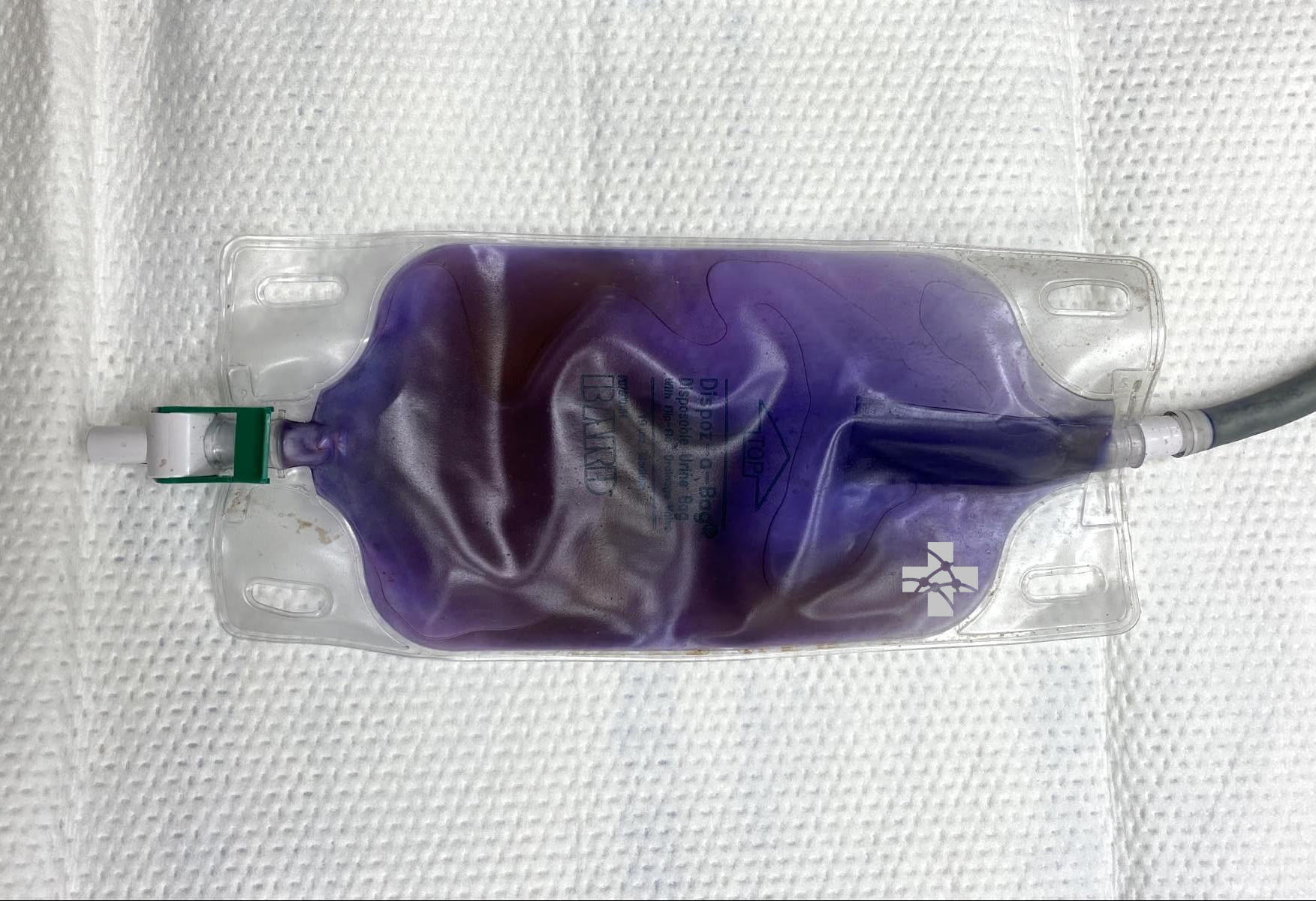 purple urine bag syndrome