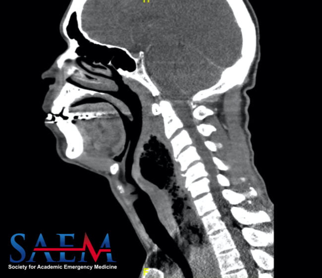Computed tomography neck