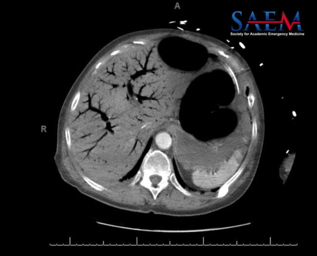 abdominal CT