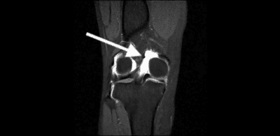 bucket handle medial meniscus tear