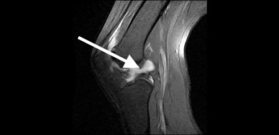 ACL tear sagittal