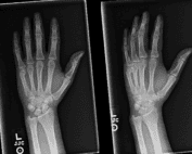 X ray boxer's fracture
