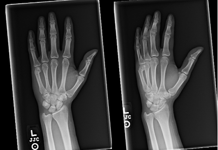 X ray boxer's fracture