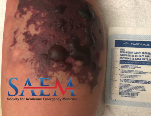 SAEM Clinical Image Series: Red, White, & Blue