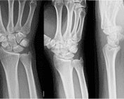 Scaphoid Fracture