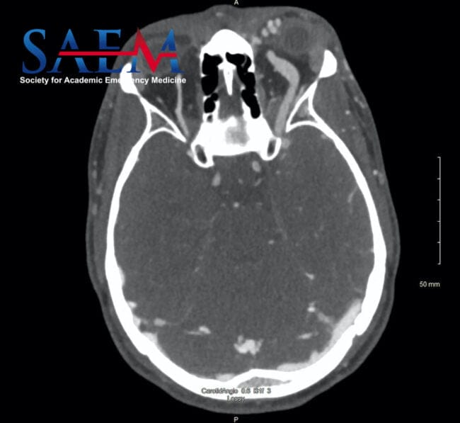 carotid cavernous fistula