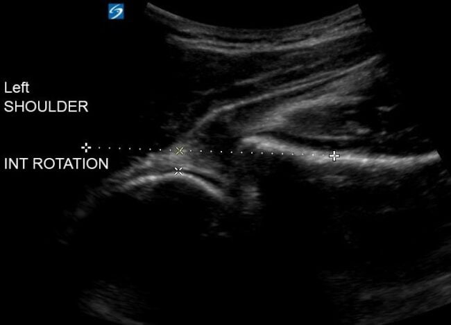 ultrasound shoulder internal rotation
