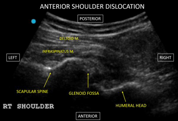 ultrasound anterior shoulder dislocation US4TW
