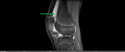 Potential complications of patellar subluxations