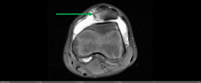 Potential complications of patellar subluxations