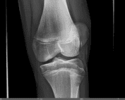 Patellar Subluxation