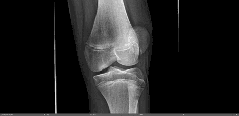 patellar subluxation