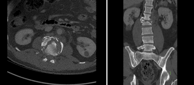 Vertebral Burst Fracture