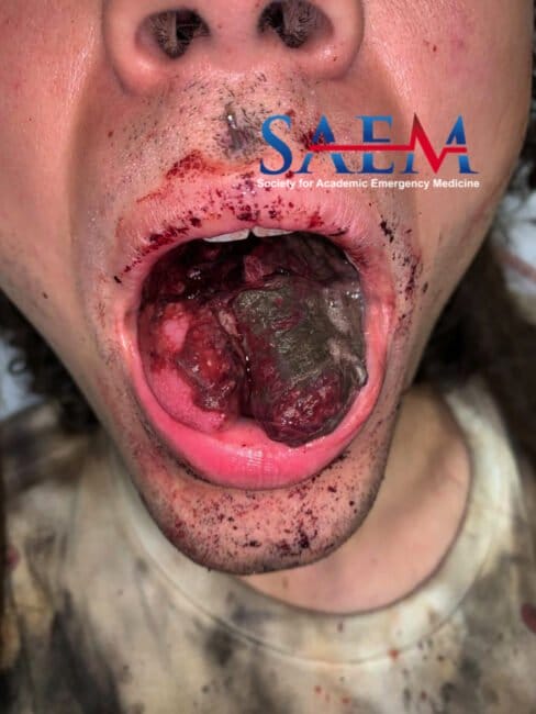 bifurcated tongue