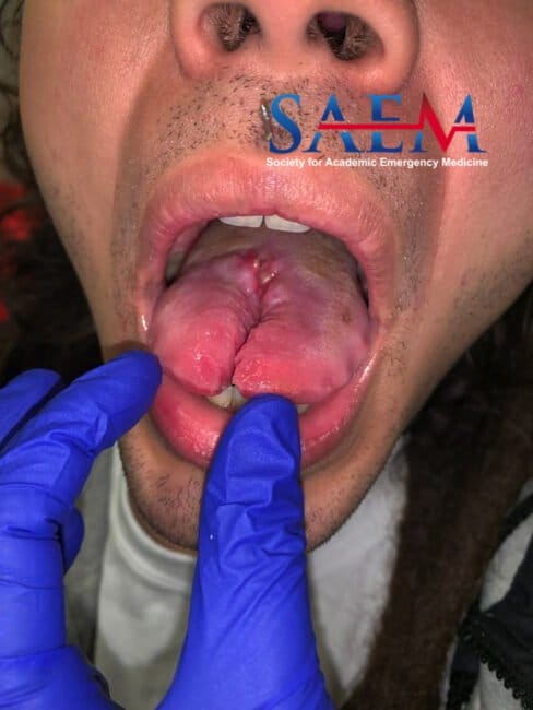 bifurcated tongue