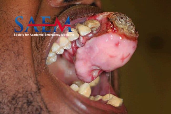 oral mass