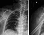 Proximal humerus fracture-dislocations