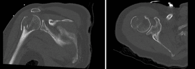 Proximal humerus fracture