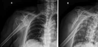 Anterior inferior shoulder dislocation with a fracture of the greater tuberosity of the humerus.