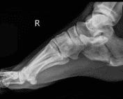 Calcaneus Fracture