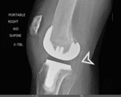 Posterior tibiofemoral arthroplasty dislocation