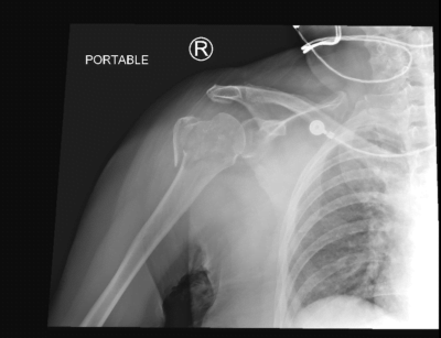 Post-reduction film with fracture of the greater tuberosity