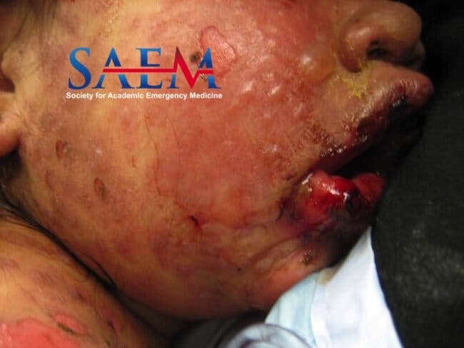 blisters bullae