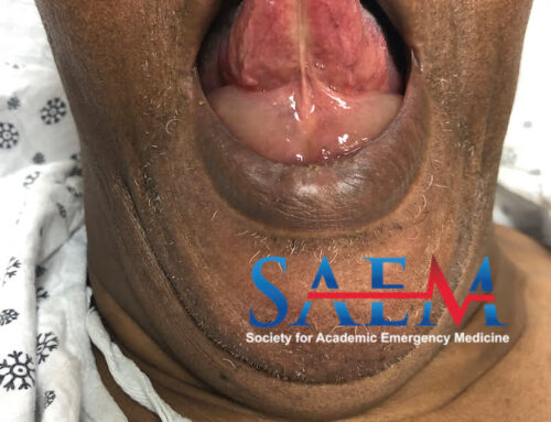 SAEM Clinical Image Series: Edema Got Your Tongue?