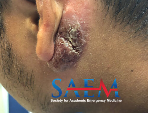 SAEM Clinical Image Series: Left Ear Mass