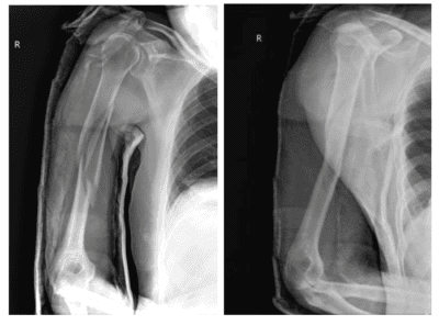 Post-reduction humeral fracture radiograph
