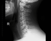 Neck pain