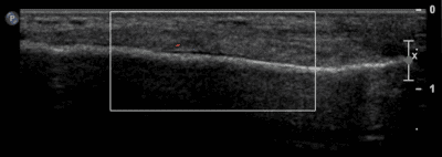 Metatarsal Stress Fracture