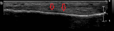 metatarsal stress fracture
