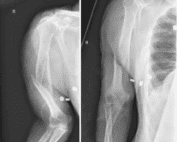 Humeral shaft fracture
