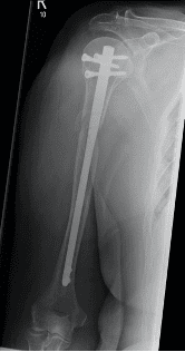 Post-operative radiographs of the right humerus with intramedullary nail