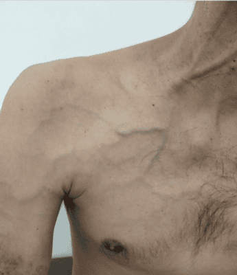 Superficial collateralization in Paget-Schrötter syndrome