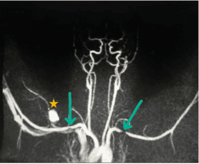 MRA demonstrating bilateral stenosis of the subclavian veins