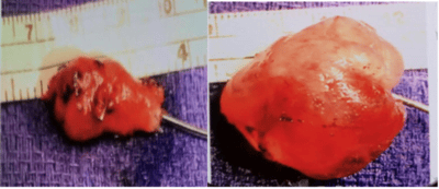 vascular varix