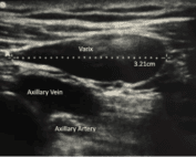 axillary varix