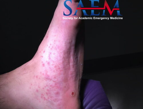 SAEM Clinical Image Series: Guess Who’s Back?
