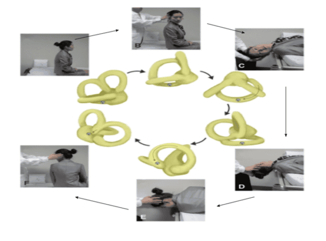 Epley Maneuver vertigo