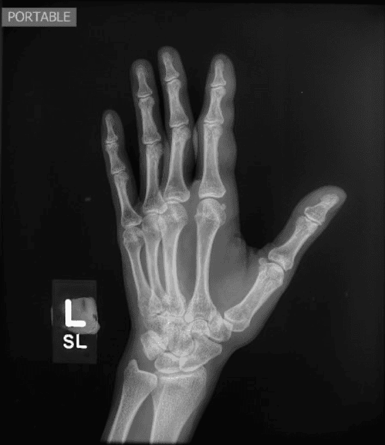 soft tissue swelling