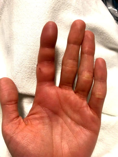 Sausage digit