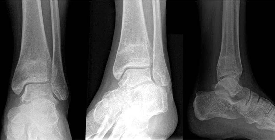 Ankle x-ray film