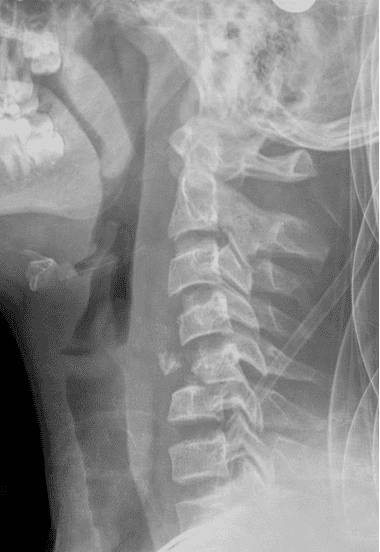 Flexion teardrop cervical spine fracture