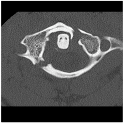 CT cervical spine of a Jefferson fracture
