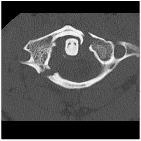 CT cervical spine demonstrating a Jefferson Fracture